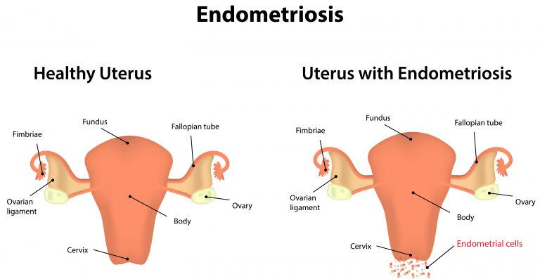 endo metriosis symptoms