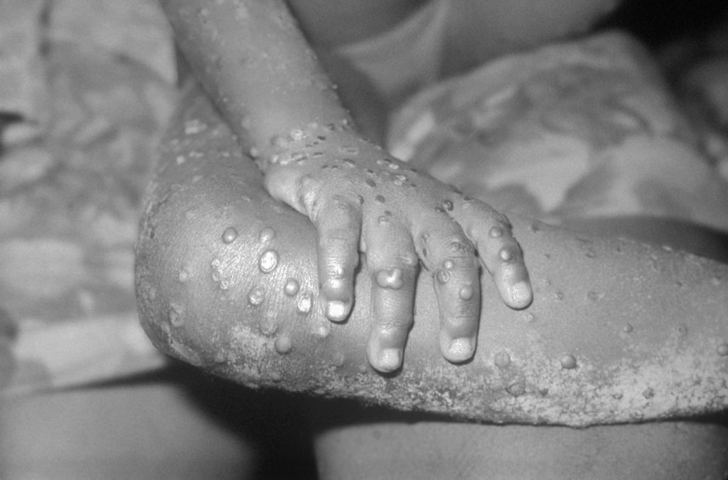 important facts about monkeypox disease