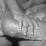 important facts about monkeypox disease