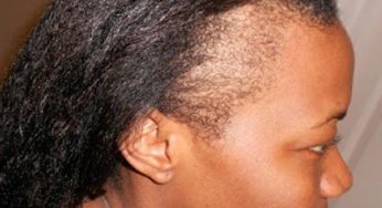 7 Reasons Why You May Be Experiencing Early Hair Loss