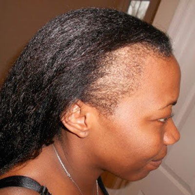 Causes Of Early Hair Loss In Women