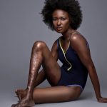 Berlange Presilus Becomes Model With An 'Ugly' Leg