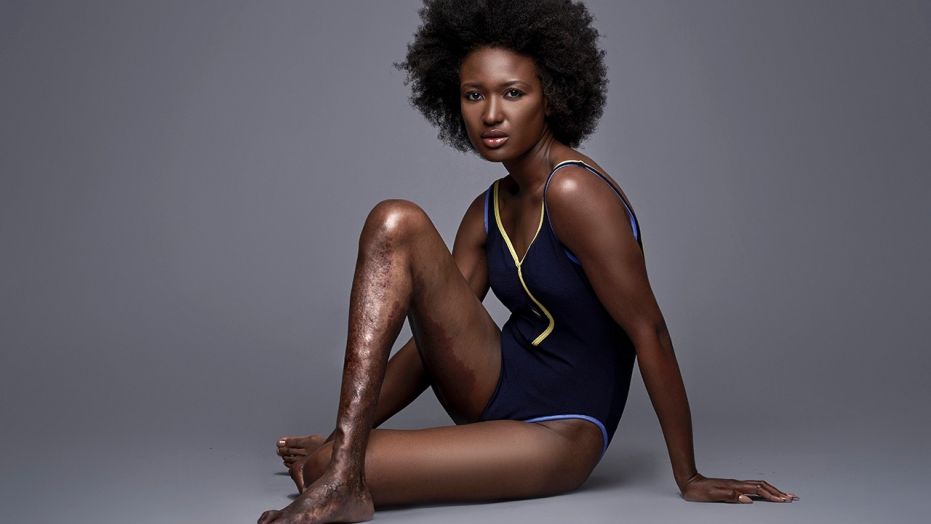 Berlange Presilus Becomes Model With An 'Ugly' Leg