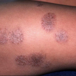 Ringworm Causes