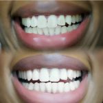 bentonite clay for teeth whitening