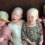 Child With Albinism