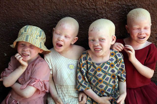Child With Albinism