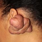 keloids home remedies