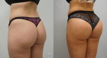 All You Should Know About Brazilian Butt Lift (BBL): Procedure, Benefits, Side Effects