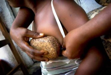 breast ironing