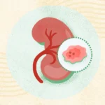 Kidney Cancer