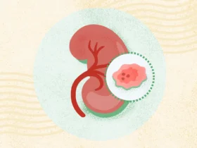 Kidney Cancer