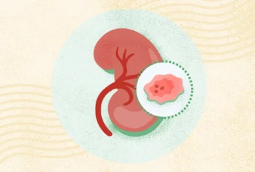 Kidney Cancer